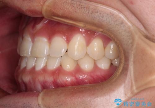 隙間の空いた前歯を治したい　上顎の部分矯正の治療後
