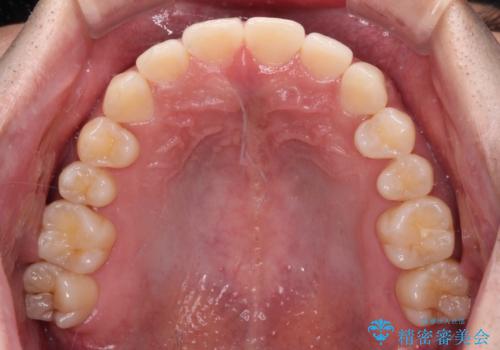 隙間の空いた前歯を治したい 上顎の部分矯正の治療後