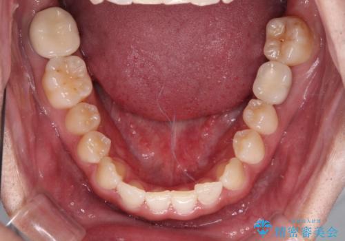 隙間の空いた前歯を治したい 上顎の部分矯正の治療後