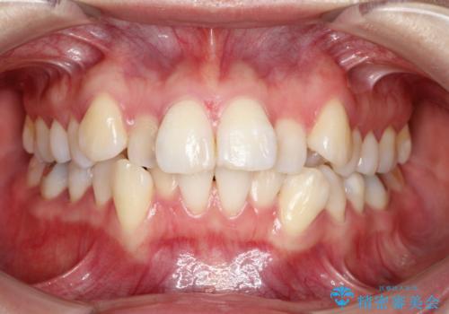 目立たないハーフリンガル矯正　抜歯矯正で口元を改善の症例 治療前