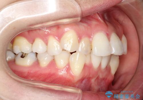 目立たないハーフリンガル矯正 抜歯矯正で口元を改善の治療前