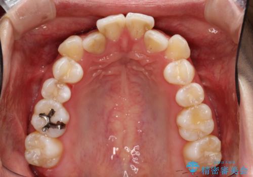 目立たないハーフリンガル矯正 抜歯矯正で口元を改善の治療前