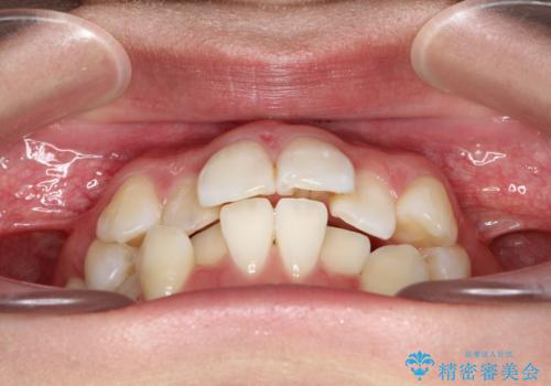 目立たないハーフリンガル矯正 抜歯矯正で口元を改善の治療前