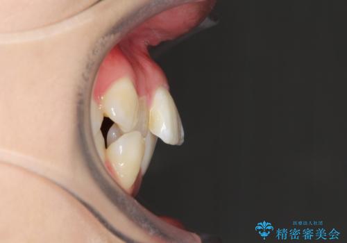 目立たないハーフリンガル矯正 抜歯矯正で口元を改善の治療前