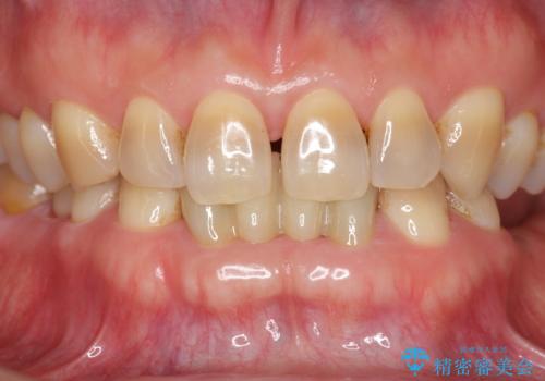 下の前歯のブリッジ 保険治療のやり替えの治療後
