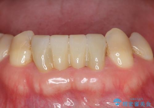 下の前歯のブリッジ 保険治療のやり替えの治療後