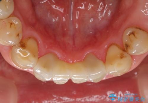 下の前歯のブリッジ 保険治療のやり替えの治療後