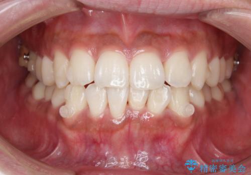 光加速矯正装置(オルソパルス)を用いた短期間での矯正治療の治療中