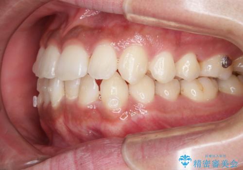 光加速矯正装置(オルソパルス)を用いた短期間での矯正治療の治療中