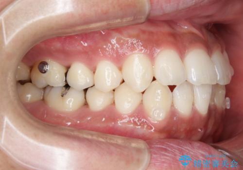 光加速矯正装置(オルソパルス)を用いた短期間での矯正治療の治療中