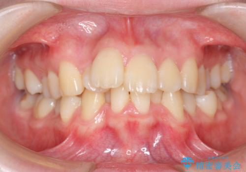 20代女性　前から5番目の歯を抜歯の症例 治療前