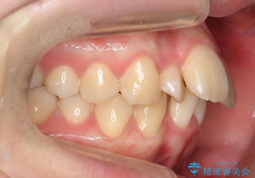 20代女性 前から5番目の歯を抜歯の治療前