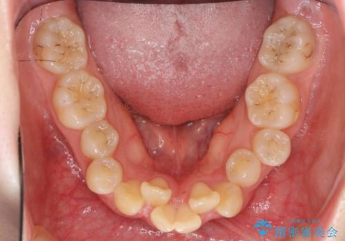 20代女性 前から5番目の歯を抜歯の治療前