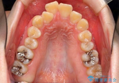 20代女性 前から5番目の歯を抜歯の治療前