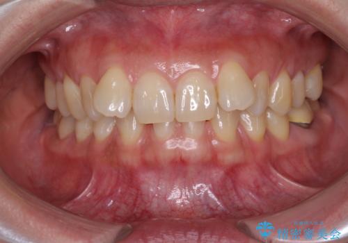 下顎2前歯の欠損　インビザラインによる抜歯矯正の症例 治療前
