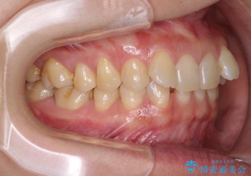 下顎2前歯の欠損 インビザラインによる抜歯矯正の治療前