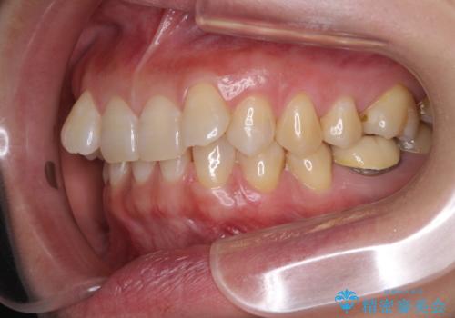 下顎2前歯の欠損　インビザラインによる抜歯矯正の治療前