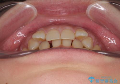 下顎2前歯の欠損　インビザラインによる抜歯矯正の治療前