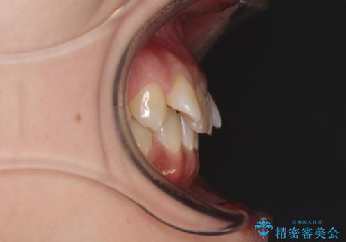 下顎2前歯の欠損 インビザラインによる抜歯矯正の治療前