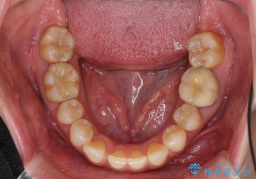 下顎2前歯の欠損 インビザラインによる抜歯矯正の治療前