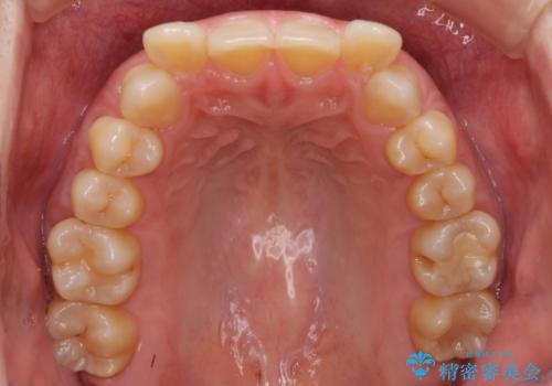下顎2前歯の欠損 インビザラインによる抜歯矯正の治療前