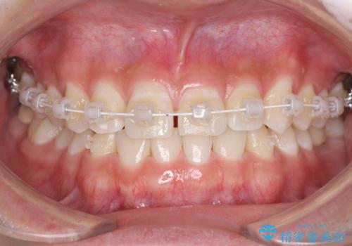 隙間の空いた前歯を治したい 上顎の部分矯正の治療中