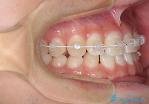 隙間の空いた前歯を治したい 上顎の部分矯正の治療中
