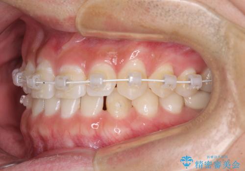隙間の空いた前歯を治したい 上顎の部分矯正の治療中