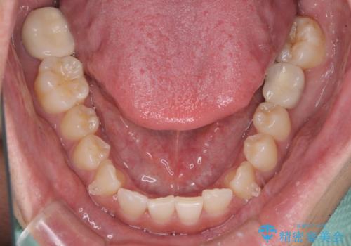 隙間の空いた前歯を治したい 上顎の部分矯正の治療中