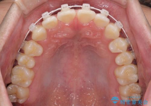 隙間の空いた前歯を治したい 上顎の部分矯正の治療中