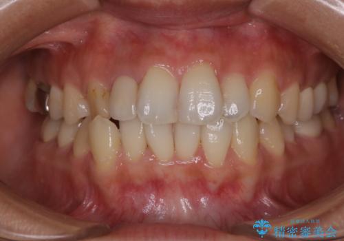 スペシャルコースでホワイトニング ナチュラルな仕上がりにの治療前