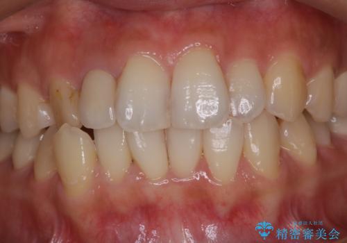 スペシャルコースでホワイトニング ナチュラルな仕上がりにの治療前