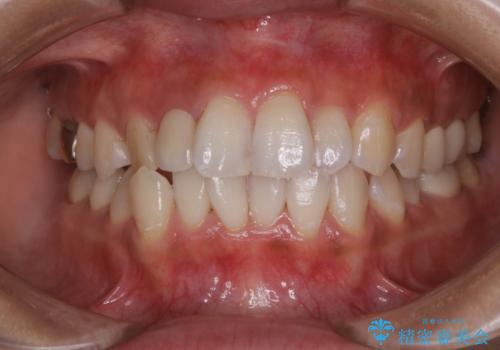 スペシャルコースでホワイトニング ナチュラルな仕上がりにの治療後