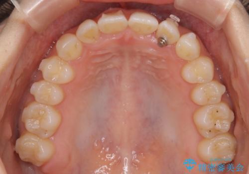 動きづらい前歯のねじれもマウスピース(インビザライン)で改善の治療中