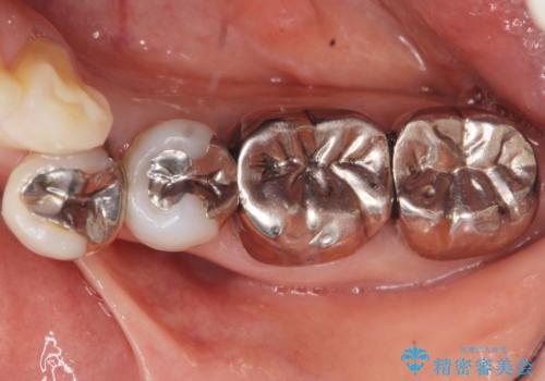 虫歯と歯並びを治したい 50代女性