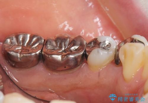 虫歯と歯並びを治したい 50代女性の治療前