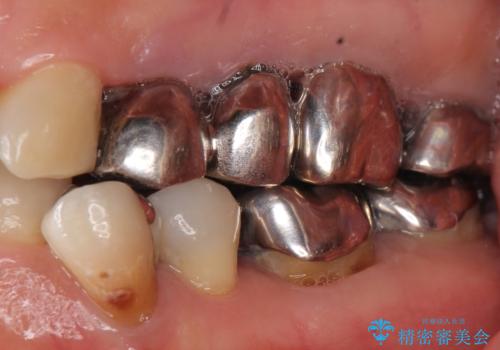 虫歯と歯並びを治したい 50代女性の治療前