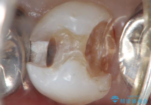 虫歯と歯並びを治したい 50代女性の治療中