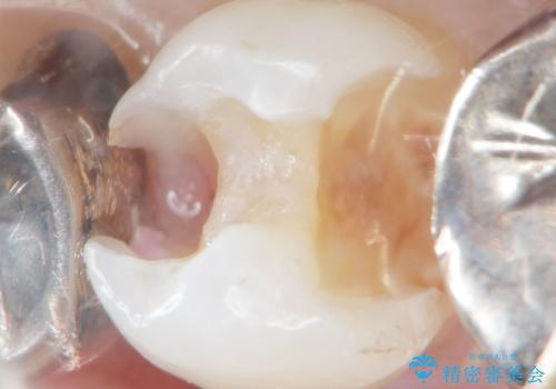 虫歯と歯並びを治したい 50代女性の治療中