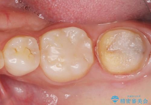 奥歯が黒い セラミッククラウンで綺麗に 30代女性の治療中