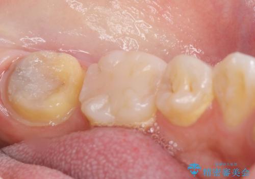 奥歯が黒い セラミッククラウンで綺麗に 30代女性の治療中