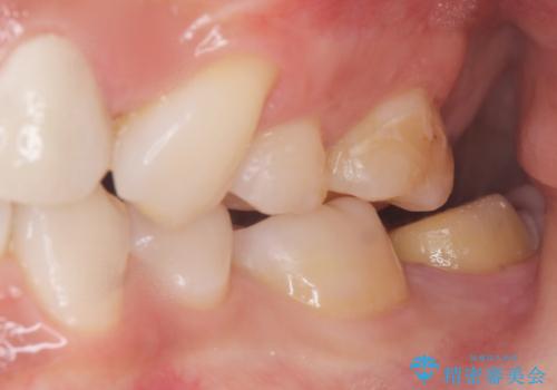 奥歯が黒い セラミッククラウンで綺麗に 30代女性の治療中