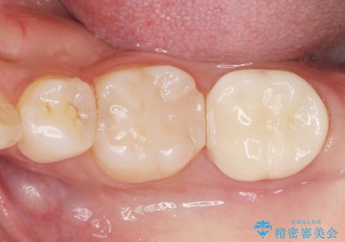 奥歯が黒い セラミッククラウンで綺麗に 30代女性の症例 治療後