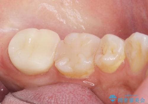 奥歯が黒い セラミッククラウンで綺麗に 30代女性の治療後