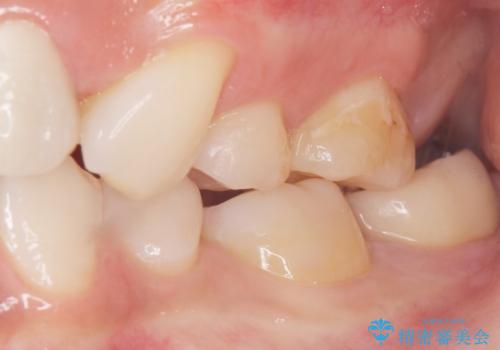 奥歯が黒い セラミッククラウンで綺麗に 30代女性の治療後
