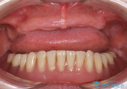 上の入れ歯がゆるくてはずれやすい　適合の良い金属床義歯　70代女性の治療中