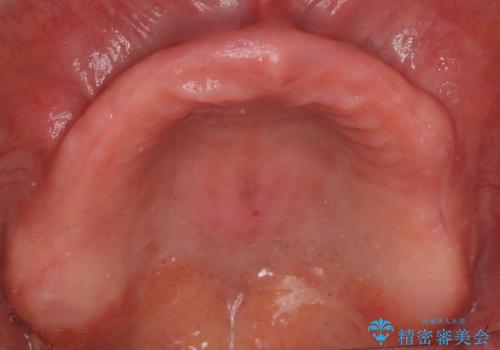 上の入れ歯がゆるくてはずれやすい 適合の良い金属床義歯 70代女性の治療中