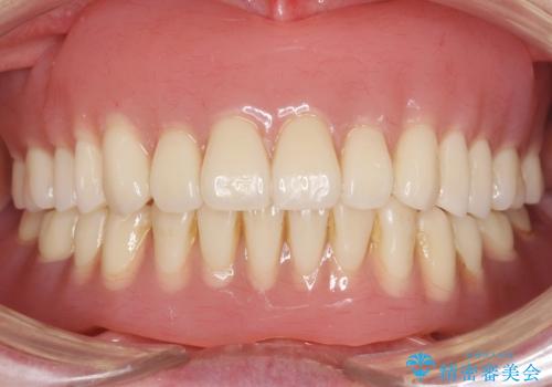上の入れ歯がゆるくてはずれやすい　適合の良い金属床義歯　70代女性の症例 治療後