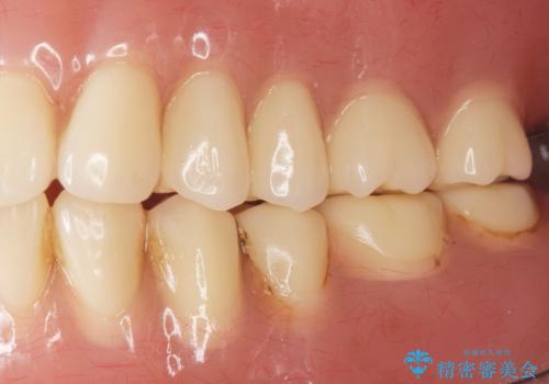 上の入れ歯がゆるくてはずれやすい　適合の良い金属床義歯　70代女性の治療後