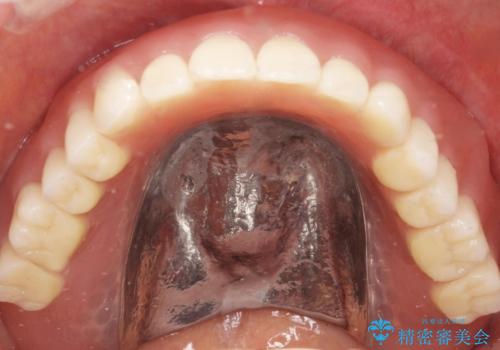 上の入れ歯がゆるくてはずれやすい　適合の良い金属床義歯　70代女性の治療後